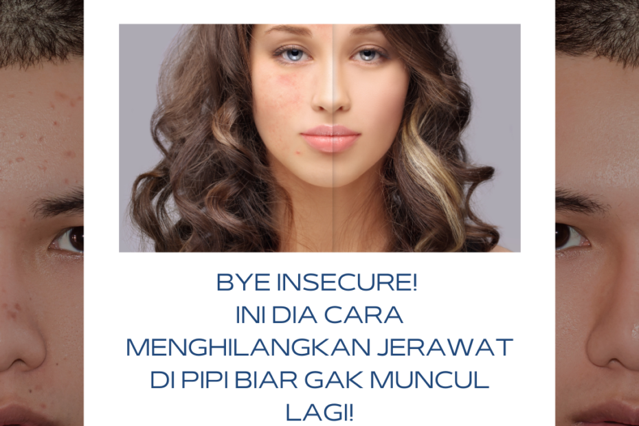 Bye Insecure! Ini Dia Cara Menghilangkan Jerawat Di Pipi Biar Gak Muncul Lagi!